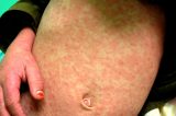 Measles Measles and COVID-19 Differences