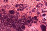 Cancer Cancer Patients May Benefit From Fecal Transplant